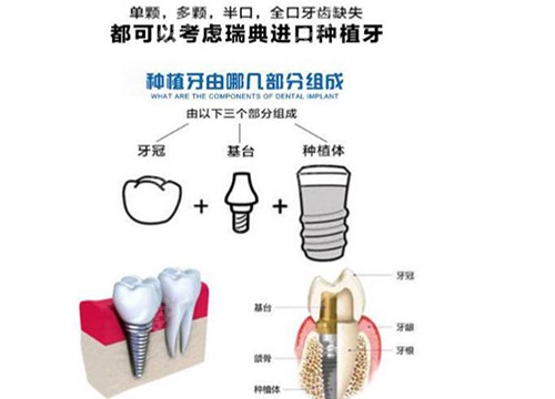 瑞典诺贝尔种植牙优势