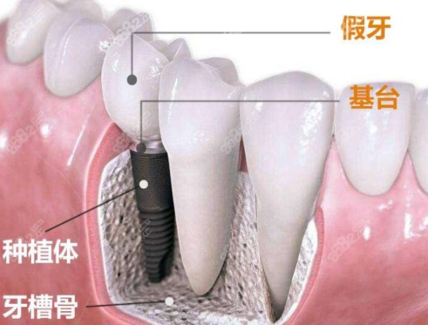 种植牙的构成
