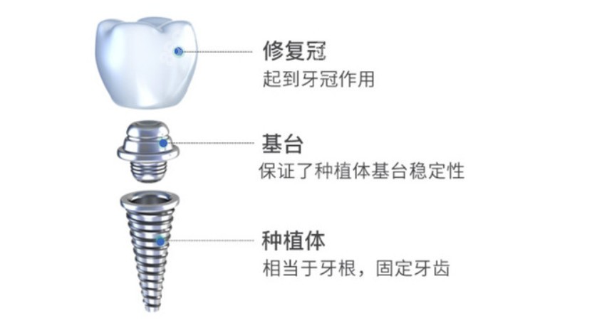 种植牙的组成和各个部件的名称