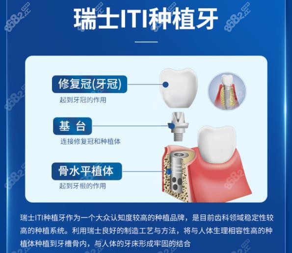 通州种牙得多少钱一颗，德系品牌价格略贵