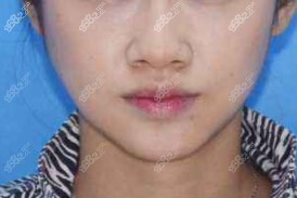 <!--<i data=20240705-sp></i>-->磨骨范例术后 <!--<i data=20240705-sp></i>-->磨骨范例术后