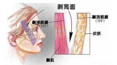 ip吻合复位提升技术除皱好吗