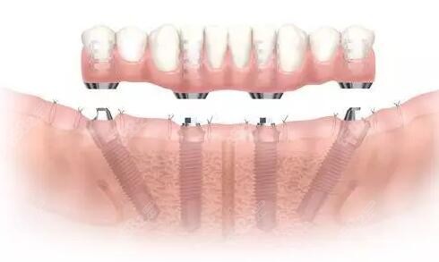 遂寧種植牙看牙價格表