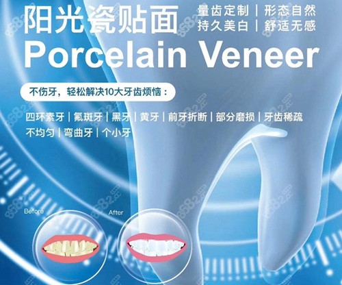<!--<i data=20240705-sp></i>-->口腔医院瓷贴面优势