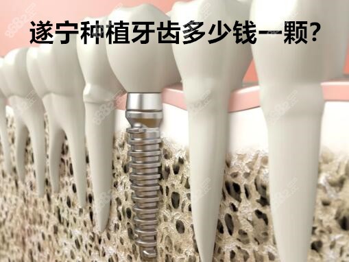 遂寧種植牙齒多少錢一顆？