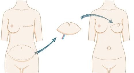 北京八大处做乳房再造好的穆大力医生手术示意图参考
