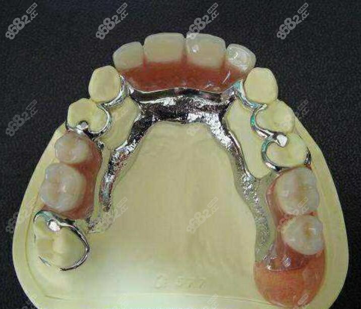 纯钛活动牙支架的图片图片