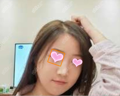 <!--<i data=20240705-sp></i>-->下颌角截骨范例术后 <!--<i data=20240705-sp></i>-->下颌角截骨范例术后