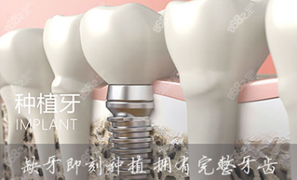 深圳爱康健口腔的即刻种植技术