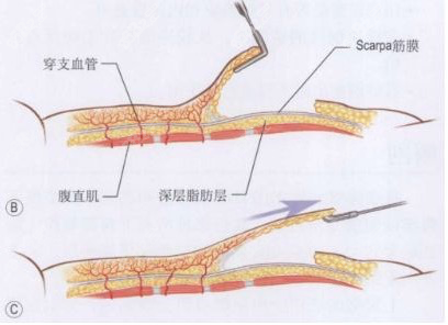 (腹壁成型术解剖示意图) (腹壁成型术解剖示意图)