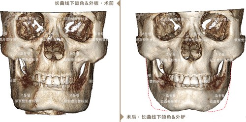 上海愉悦美联臣<!--<i data=20240705-sp></i>-->磨骨术前术后对比