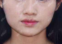 <!--<i data=20240705-sp></i>-->磨骨范例术前 <!--<i data=20240705-sp></i>-->磨骨范例术前