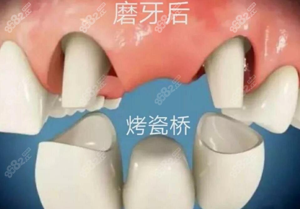 镶牙之固定义齿
