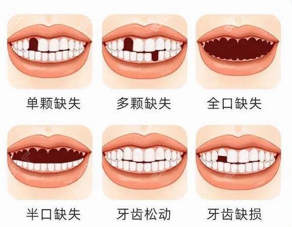 松江牙科医院种植牙适应症状