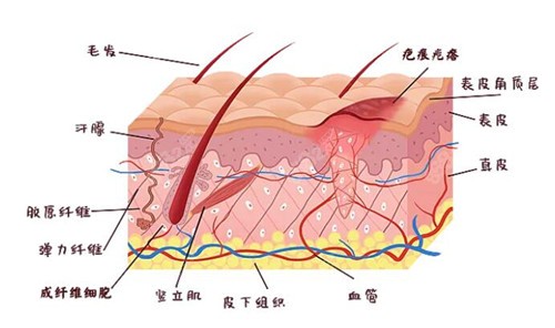 疤痕增生的原理