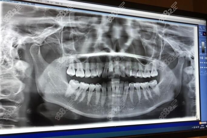 松江贝德口腔牙齿矫正拍片图像