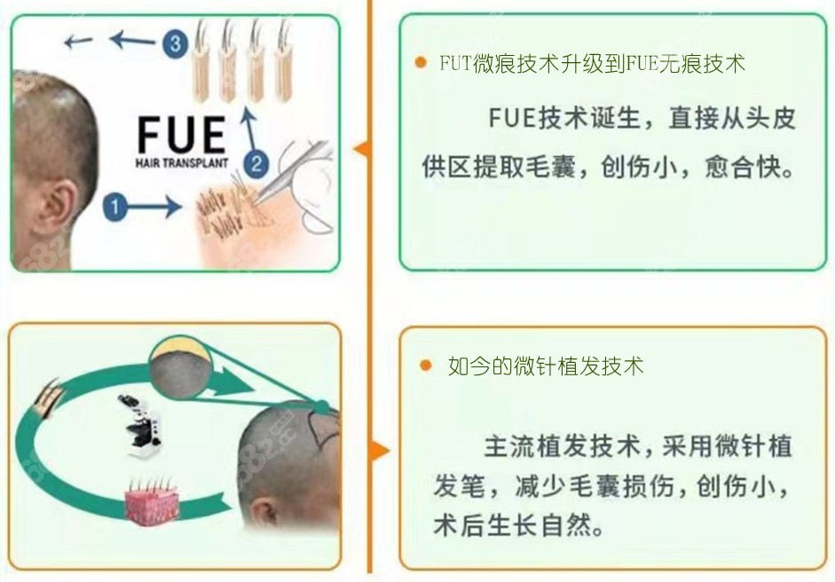 植发技术的先进程度决定了一万元植发的面积