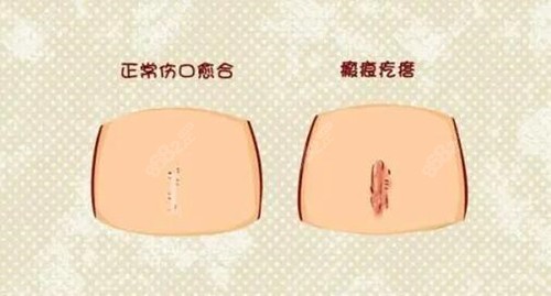 成都疤研治疗疤痕前后对比
