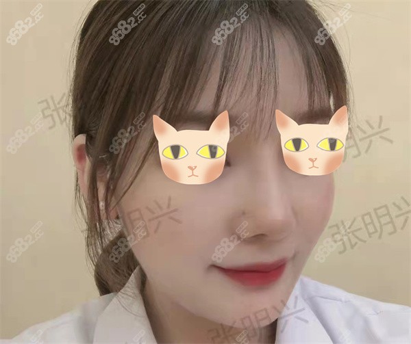 广州华美张明兴做鼻子实例1