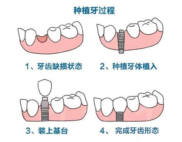 瑞泰齿科种植牙过程