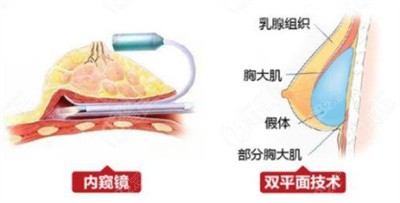 内窥镜丰胸