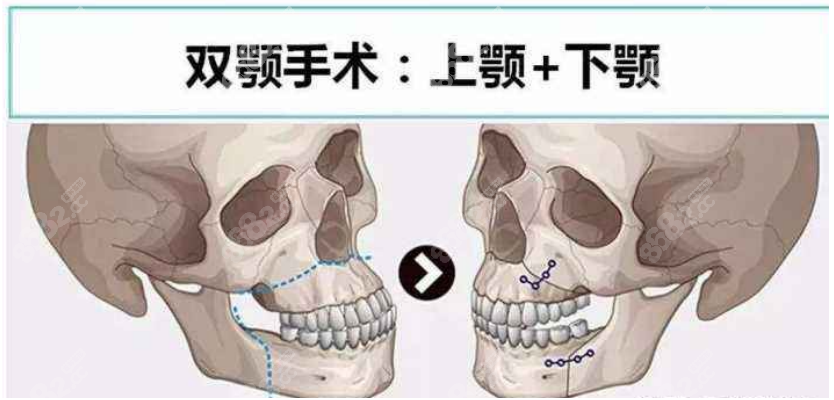 <!--<i data=20240705-sp></i>-->做正颌手术费用大概多少