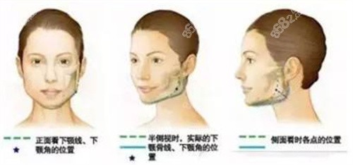 Vline瓜子脸成型术