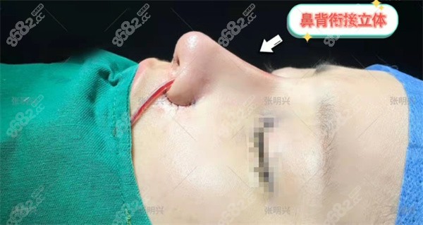 广州华美张明兴做鼻子实例2
