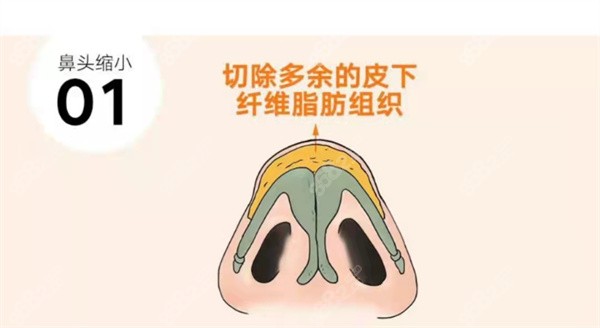 广州华美张明兴做鼻子技术特色