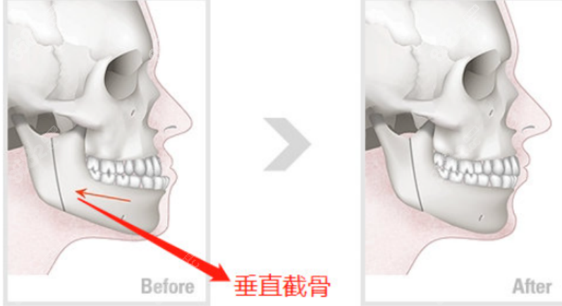 何锦泉做骨性地包天手术多少钱？