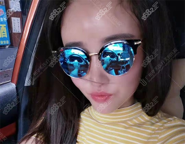 广州华美张明兴做鼻子实例3