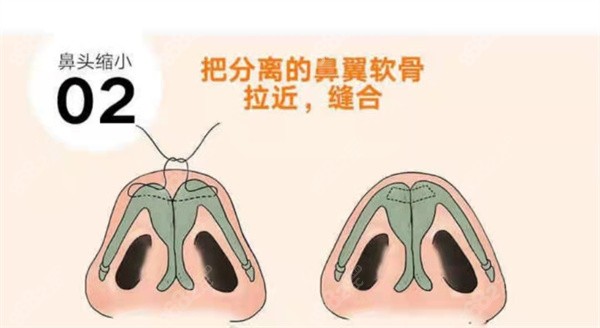 广州华美张明兴做鼻子技术特色
