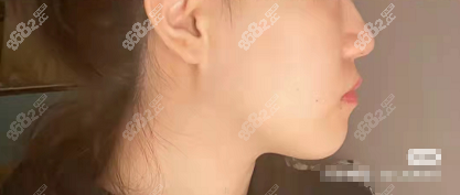 张栋梁正畸之后