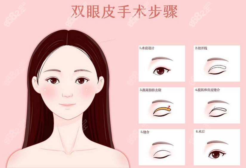 甘泉涌医生的技术还蛮厉害的，他可以做到隐藏疤痕