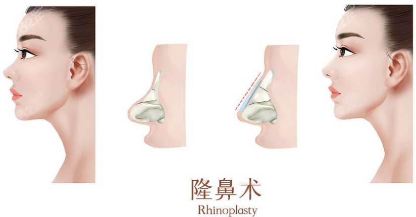 甘泉涌医生做的隆鼻手术还蛮好的