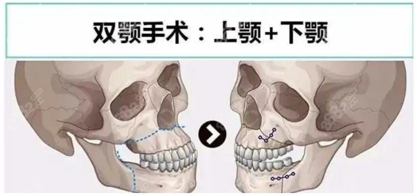 <!--<i data=20240705-sp></i>-->做正颌手术价格大概在10-20万之间，并不是十八万