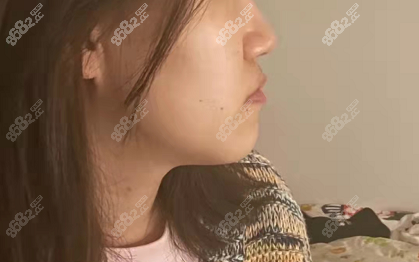 张栋梁正畸之前