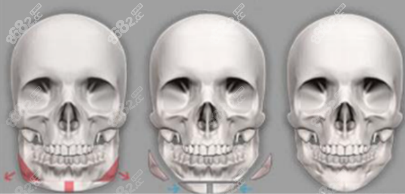 <!--<i data=20240705-sp></i>-->醫(yī)生做磨骨手術(shù)怎么樣？