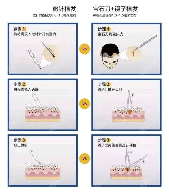 微针技术与FUE技术的区别