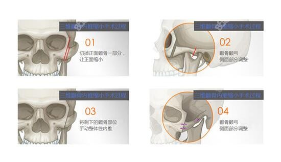 颧骨颧弓内推手术过程
