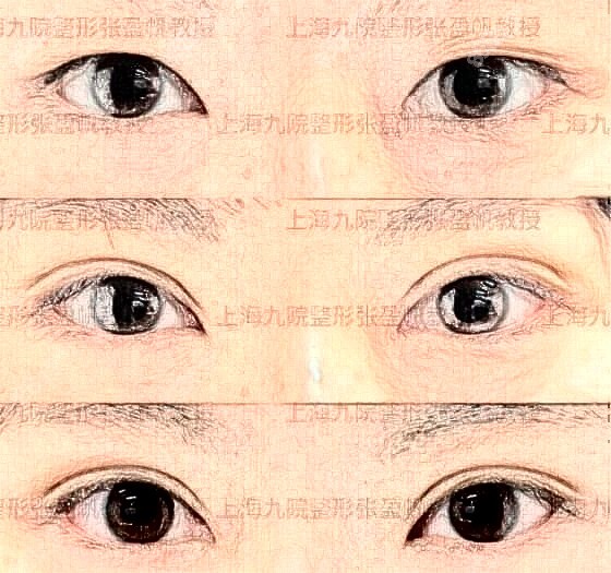<!--<i data=20240705-sp></i>-->双眼皮真人对比照