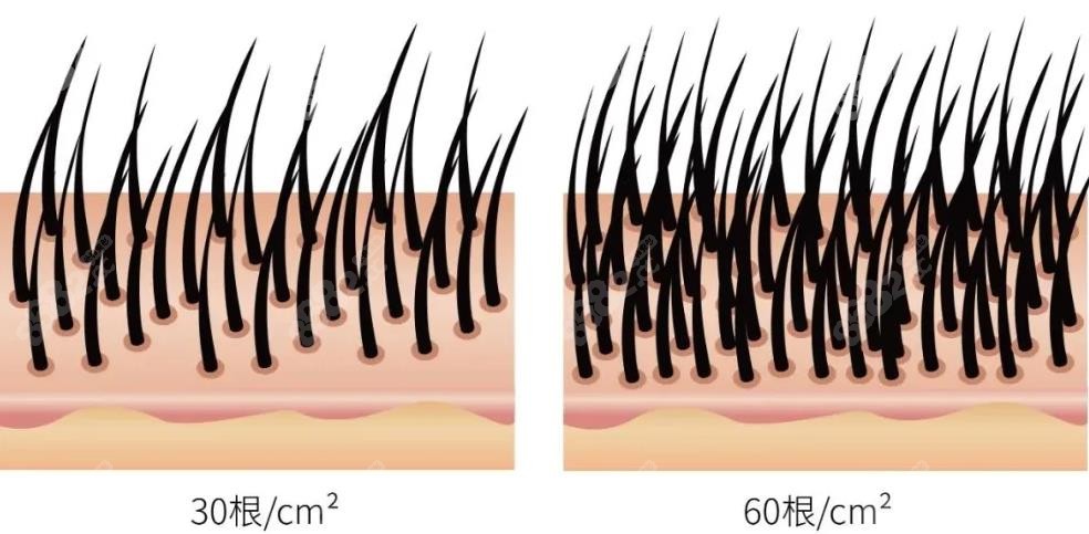 30根和60根植发密度对比图