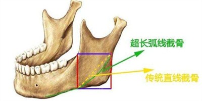 下颌角截骨