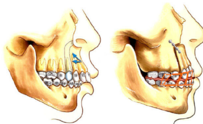 正颌手术