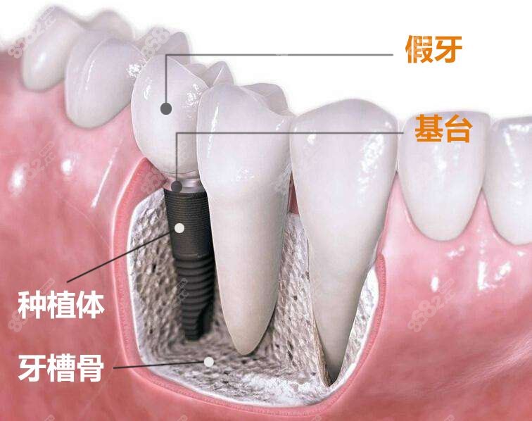 更新廣安市種植牙收費價目表以種牙便宜靠譜的牙科為依據