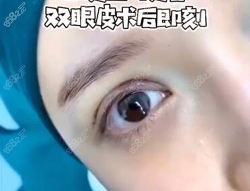翟彦刚做双眼皮术后