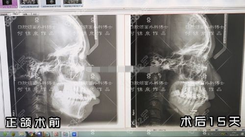 何锦泉正颌手术前后对比