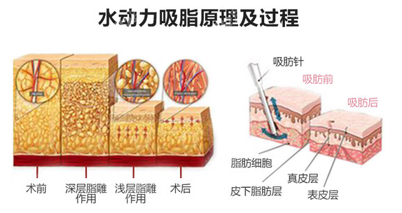 苏州吸脂排名前五医院——苏州康美水动力吸脂