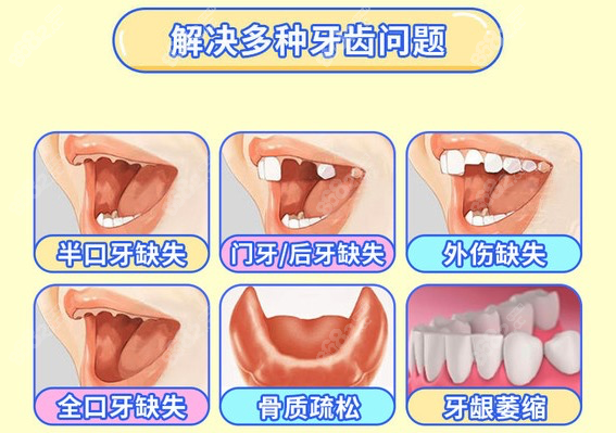 维恩口腔种植牙怎么样