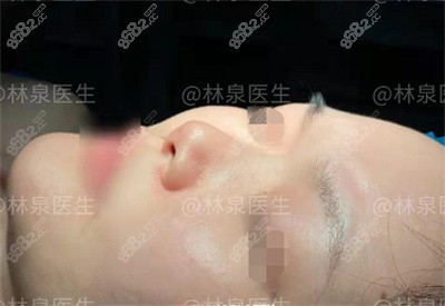 隆鼻术前